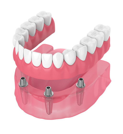 Illustration d'une prothèse dentaire complète sur implants