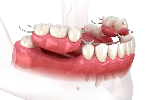 Image de synthèse d'une prothèse dentaire amovible partielle